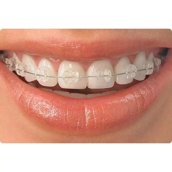 What-are-ceramic-braces-how-are-they-made